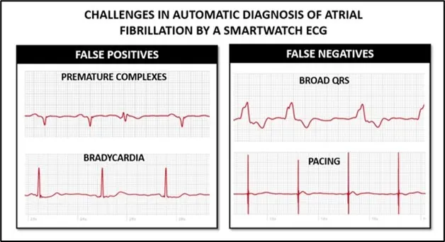 Graph showing example of false positives and false negatives in smartwatch ECG