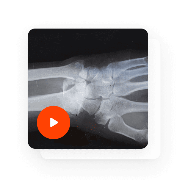 Hand Fracture Radiology Video Feature