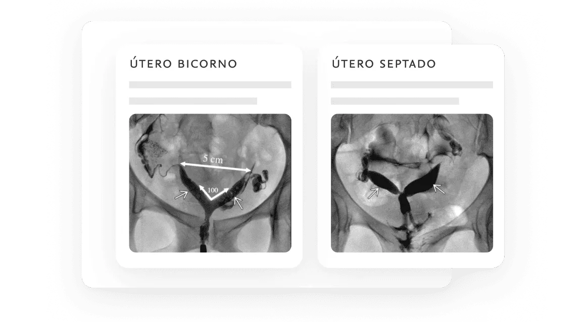 X-ray photographs of a bicornate uterus and a septate uterus