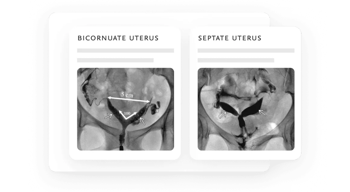 Comparing Diagnosis Bicornuate Septate Uterus Benefit