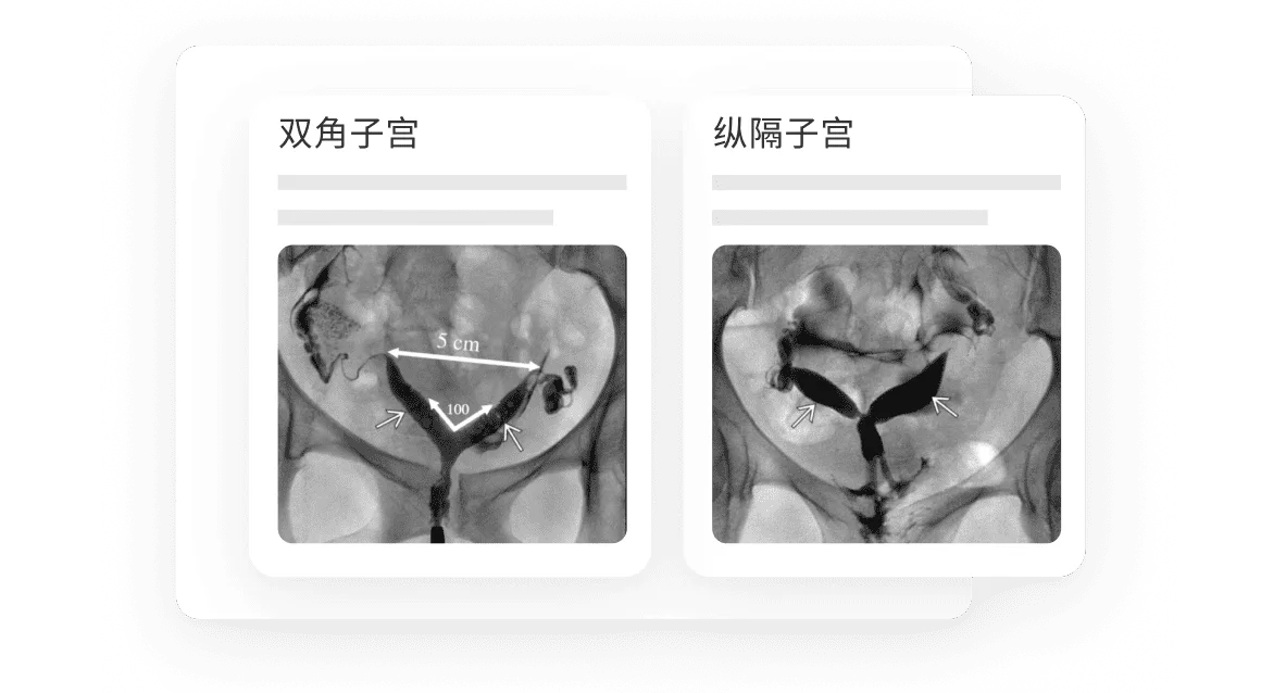 Comparing Diagnosis Bicornuate Septate Uterus Benefit