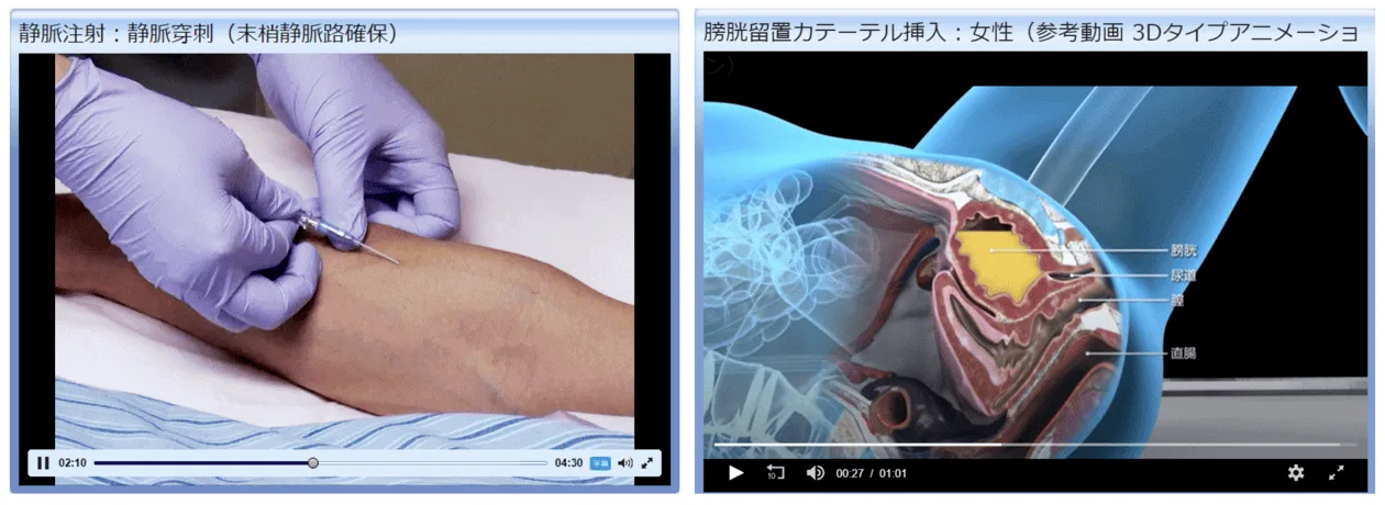 Stills from video showing procedure
