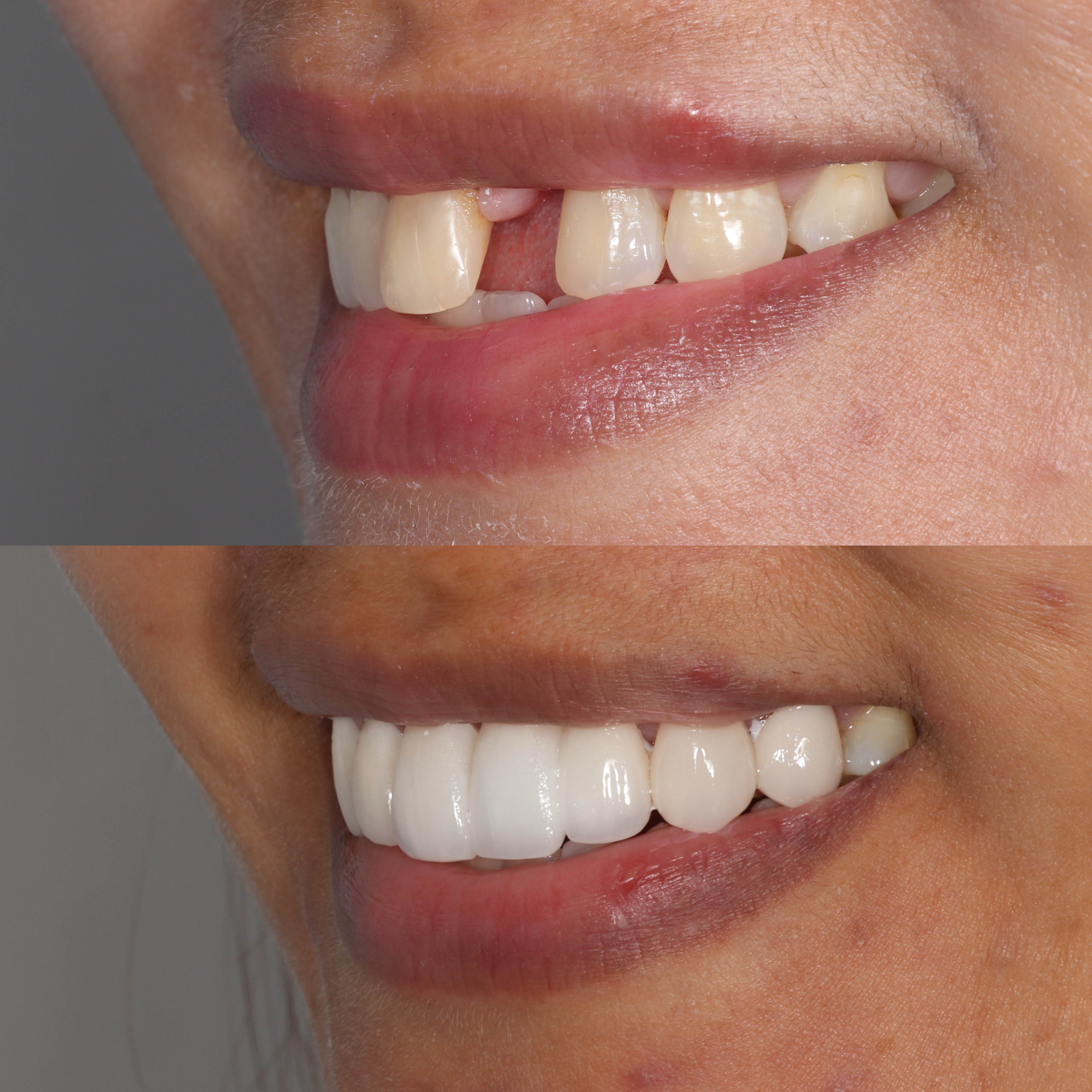 Fixed Dental Bridge in Cebu: Cost, Zirconia Crowns, and Treatment for ...