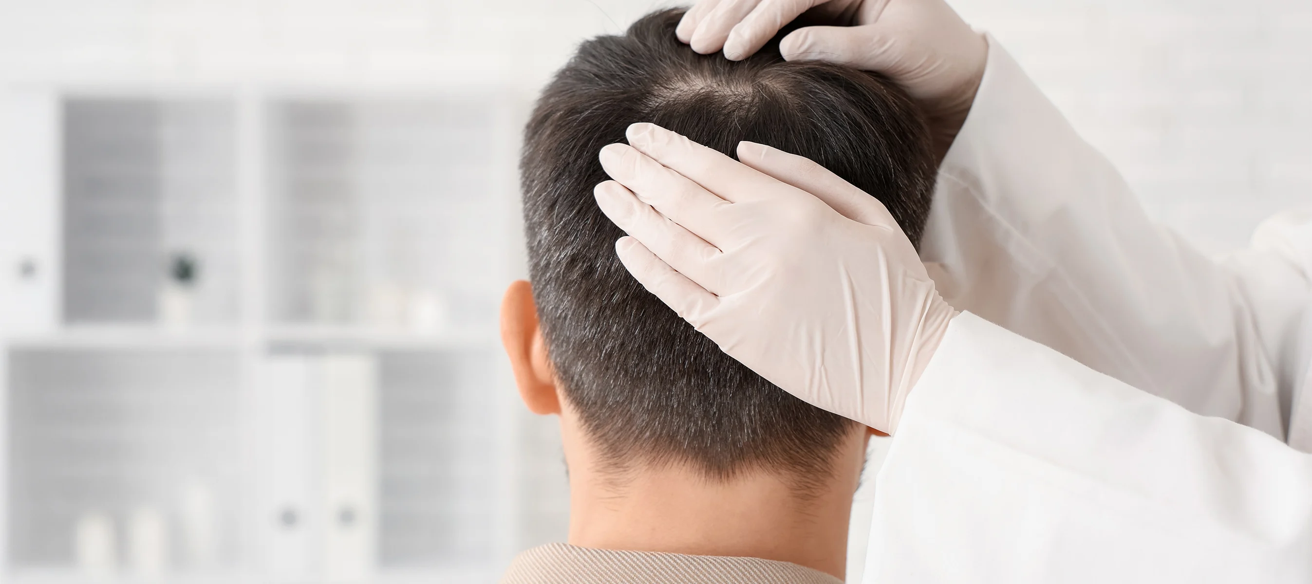 Understanding Dandruff: Causes, Symptoms and Treatments