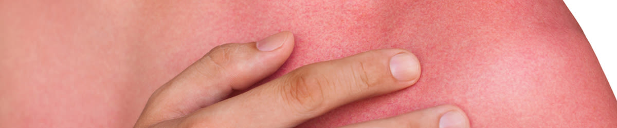 comment soulager le coup de soleil, l’apaiser et le soigner