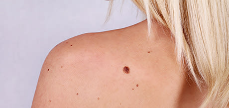 Tout savoir sur les allergies solaires
