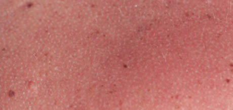 Allergies solaires