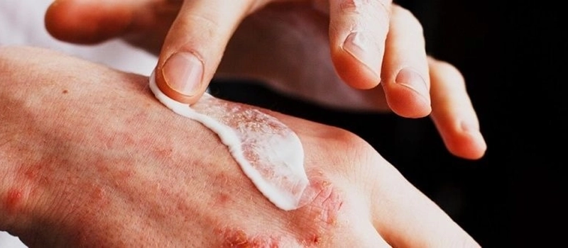 Understanding Dry Skin and Atopic Dermatitis 