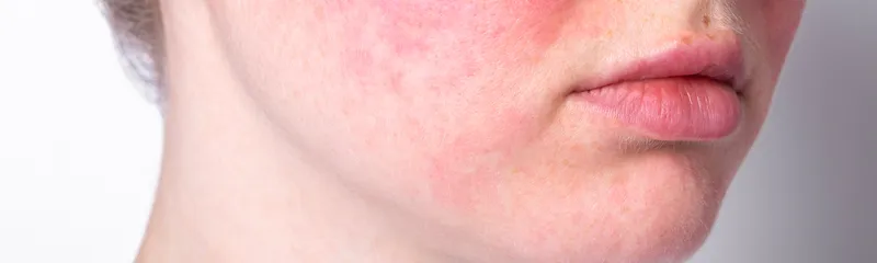 What Is Rhofade - What Is Rhofade Used For