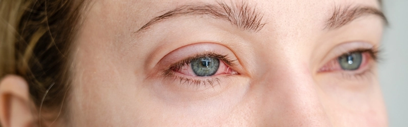 What Causes Itchy Eyes Besides Allergies