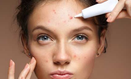 What Causes Acne?
