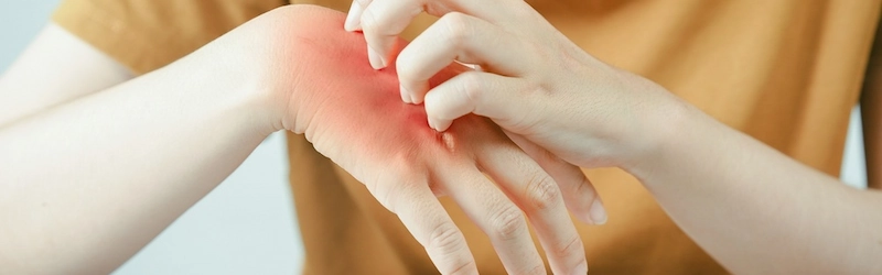 What Causes Eczema Flare-Ups? Common Triggers What Causes Eczema Flare-Ups? Common Triggers