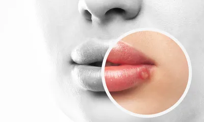 Is Herpes a Parasitic Infection 