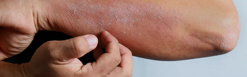 How to Tell If You Have Oily or Dry Skin