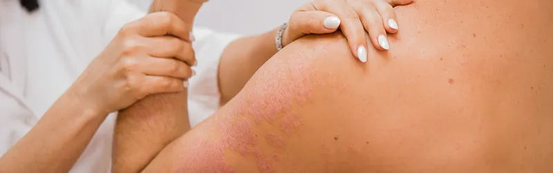 Psoriasis vs Syphilis: Key Differences