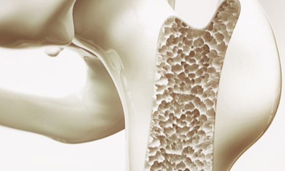 Can Osteopenia be Reversed?