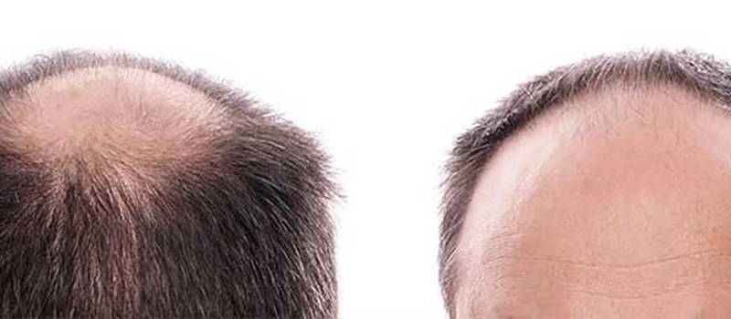 5 New Hair Loss Cure Options