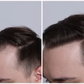 Does Finasteride Regrow Hair? Results