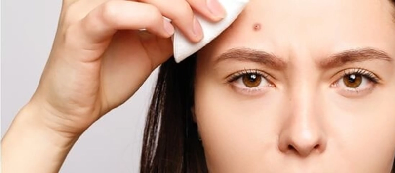 How Acne Medication Limits Skin Breakouts 