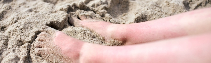 What Causes Swollen Feet in Hot Weather