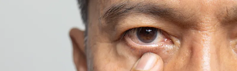 What Is the Difference Between Glaucoma and Cataracts