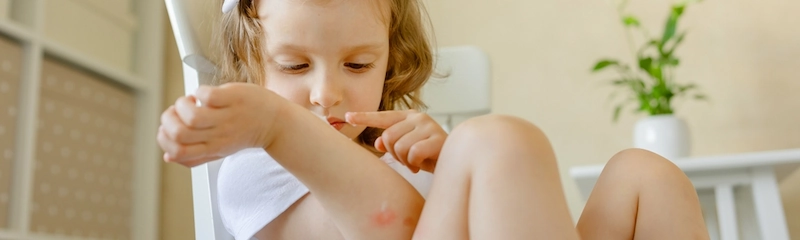 What Helps With Insect Bite Reactions