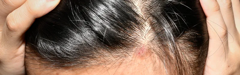 How to Treat Fungal Infection in Scalp