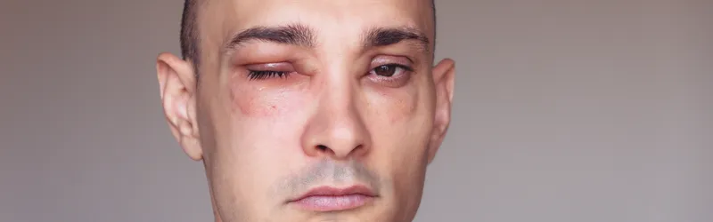 HAE Symptoms and Hereditary Angioedema Type 3