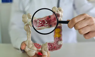 Ulcerative Colitis Remedies