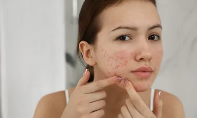 Does Microdermabrasion Help Acne?