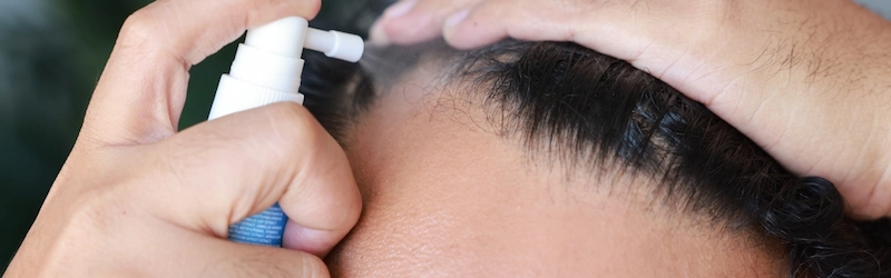 Is Oral Minoxidil Better Than Topical? Compare Options