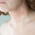 How Long Does Contact Dermatitis Last? Recovery Guide