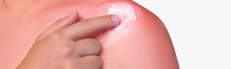 How to Treat Sunburn Fast
