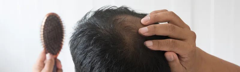 What Are the Different Types of Alopecia