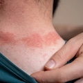What Does Eczema Look Like? Signs and Symptoms