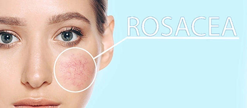 How Do You Clear Up Rosacea?