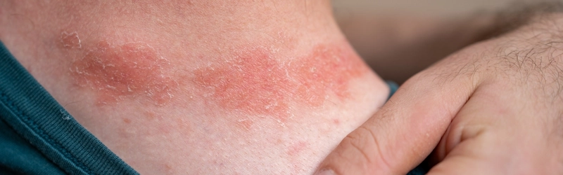 What Does Eczema Look Like? Signs and Symptoms What Does Eczema Look Like? Signs and Symptoms