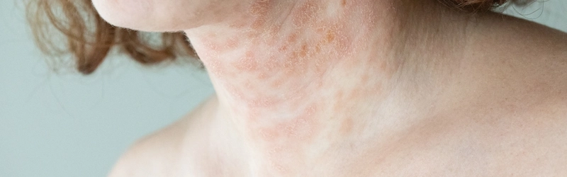 How Long Does Contact Dermatitis Last? Recovery Guide How Long Does Contact Dermatitis Last? Recovery Guide