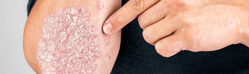 Does Exfoliating Make Psoriasis Worse