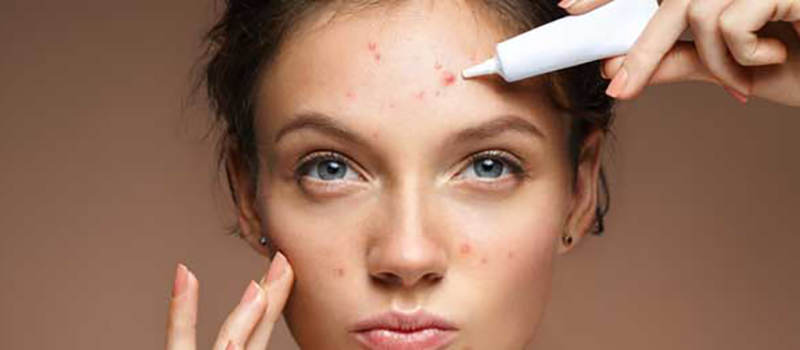 What Causes Acne in Adolescents and Adults? Dispel the Myths