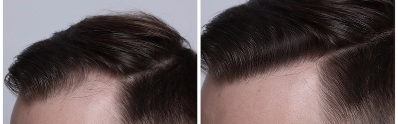 Does Finasteride Regrow Hair? Results Does Finasteride Regrow Hair? Results