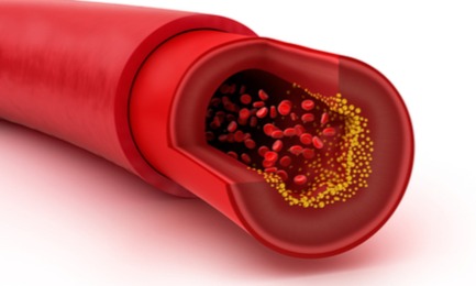 Is Zetia a Statin?