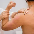 Psoriasis vs Syphilis: Key Differences