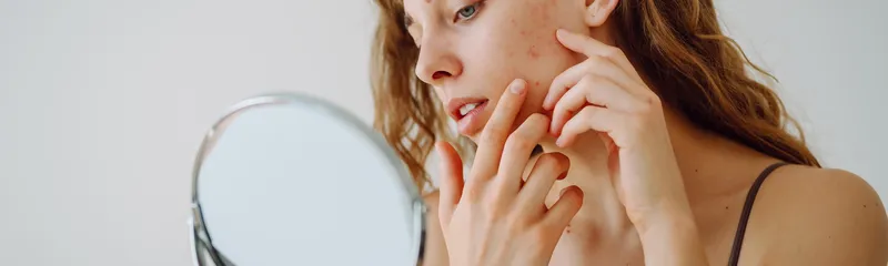 Can Microneedling Cause Acne