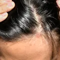 How to Treat Fungal Infection in Scalp