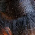 Can Listerine Kill Lice Can Listerine Kill Lice