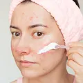 How to Apply Soolantra Cream How to Apply Soolantra Cream
