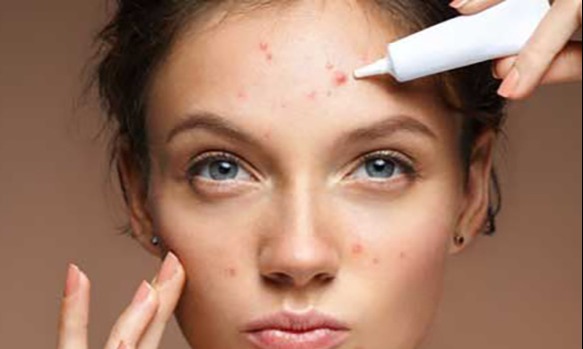 What Causes Acne in Adolescents and Adults? Dispel the Myths