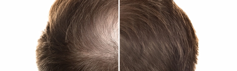 Does Finasteride Regrow Hair? Results and Timeline