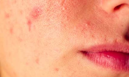 How to Get Rid of Acne?